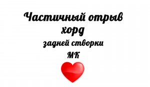 Частичный отрыв хорд задней створки митрального клапана на УЗИ сердца