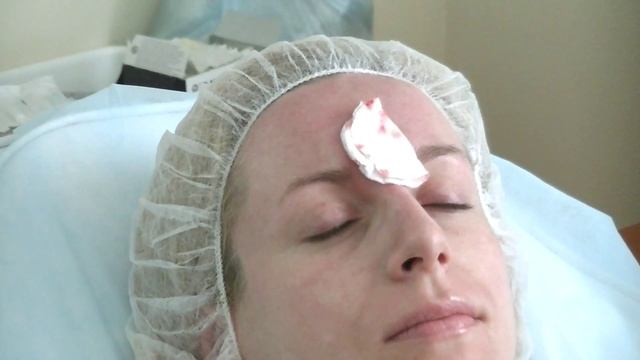 Межбровная, носолезная Restylane Perlane смотреть онлайн