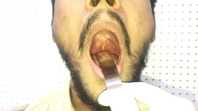 Mouth Examination - Examination of Oral Cavity and Oropharynx- Dr Mohan Bansal (Like & Subsribe) смотреть онлайн