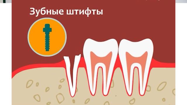 Лечим страх перед стоматологией. Часть7. Боюсь ставить штифт смотреть онлайн