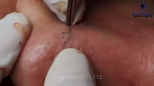 Чистка лица. Прыщи, угри и чёрные точки. Face cleaning. Pimples, blackheads, and black dots.
