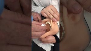 Мандибулярна и Торусальная анестезия . Анестезии на нижней челюсти.