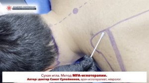 Сухая игла. LEVATOR SCAPULAE. Мышца, поднимающая лопатку. Мастер-класс врача-иглотерапевта.