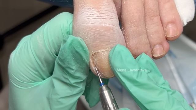 Зачистка онихолизиса / как делать зачистку онихолизиса / зачем делать зачистку / онихолизис смотреть онлайн