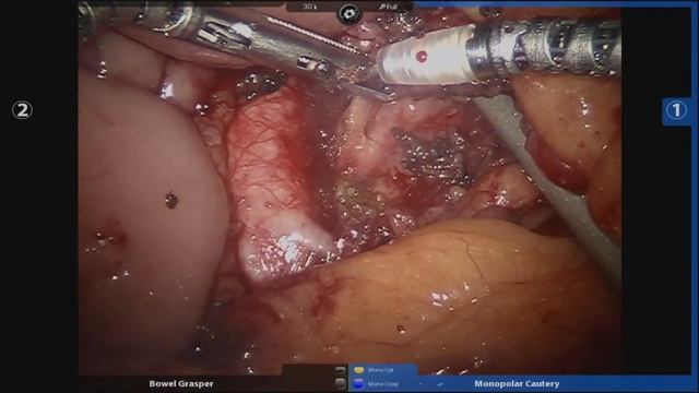 Robotic Lymph Node Dissection смотреть онлайн