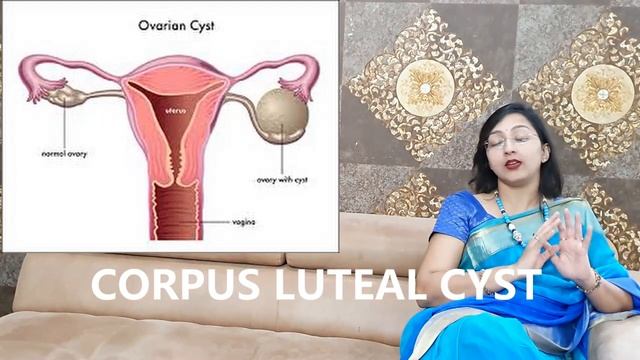सोनोग्राफी में ADNEXAL LESION कारण और इलाज смотреть онлайн