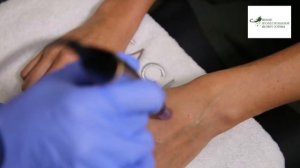 Фракционная мезотерапия рук