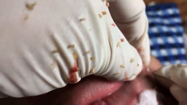 ПРЫЩИ УГРИ НА ЛИЦЕ !!!ДАВЛЮ !!!как избавиться от прыщей !ЧЕРНЫЕ ТОЧКИУГРИ ПРЫЩИ НА ЛИЦЕ ДАВЛЮ !!!ка