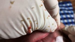 ПРЫЩИ УГРИ НА ЛИЦЕ !!!ДАВЛЮ !!!как избавиться от прыщей !ЧЕРНЫЕ ТОЧКИУГРИ ПРЫЩИ НА ЛИЦЕ ДАВЛЮ !!!ка