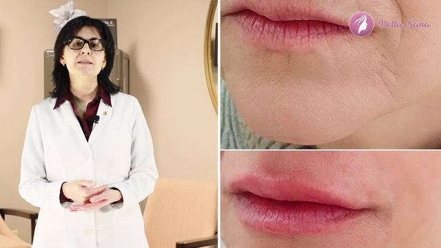 Микронидлинг (Microneedling) - популярная косметическая услуга в мед спа Bella Sana смотреть онлайн
