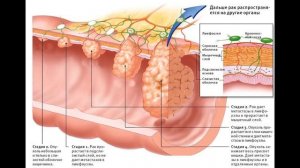 Рак прямой кишки первые симптомы