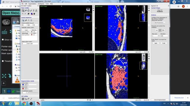 Medseg.ai And ITK SNAP Lungs GGO + Consolidation Segmentation Process. Part 2 (rus)