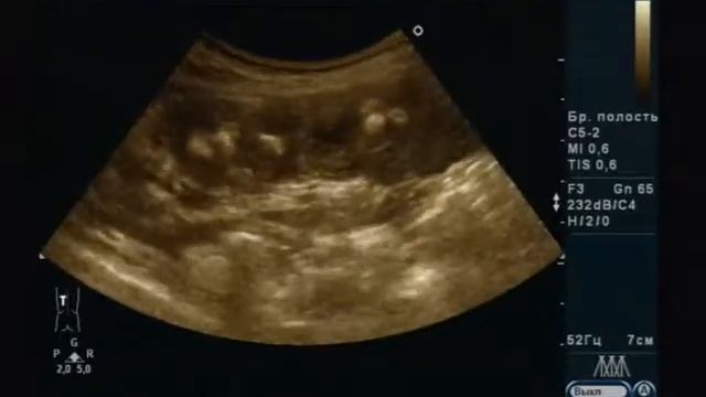 Анонс видео УЗИ к лекции "Ультразвуковая диагностика мочекаменной болезни" смотреть онлайн