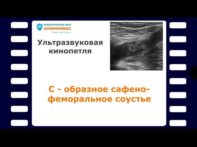 С - образное сафено-феморальное соустье смотреть онлайн