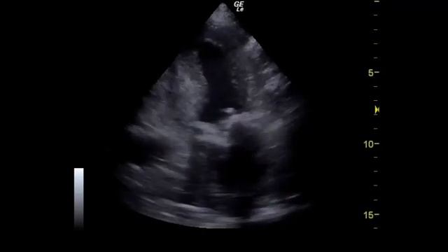 echocardiography 109 years old heart - beautiful case - Salvatore смотреть онлайн