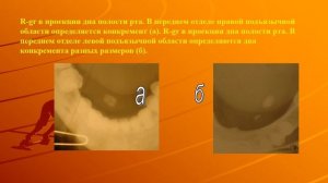 Слюннокаменная болезнь