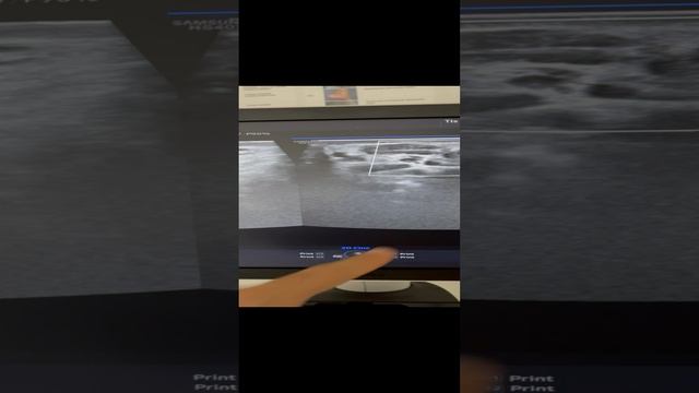 Варикоцеле. Узи сосудов. Флеболог Москва. Урология. Сосудистый хирург Москва смотреть онлайн