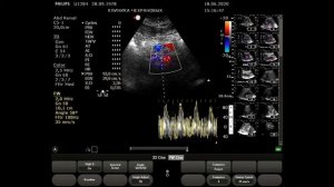 УЗИ сосудов почек (дуплексное сканирование, УЗДГ почечных артерий