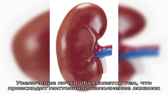 Одна почка меньше другой у детей и взрослых смотреть онлайн