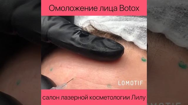 Инъекции Ботокса Салон Лилу Кременчуг