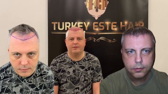 Идеальный результат пересадки волос через 5 месяцев #пересадкаволос смотреть онлайн