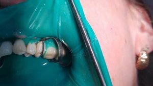 Снятие мостовидного протеза с опорой 25-27.#rubberdam #коронканазуб