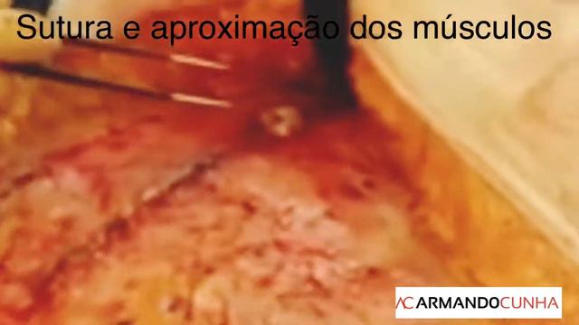 Abdominoplastia - Passo-a-Passo