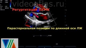 Пролапс ПСМК и ЗСМК (еще примеры)