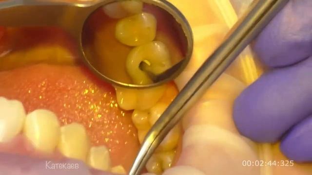 Фиксация коронки на имплантате смотреть онлайн