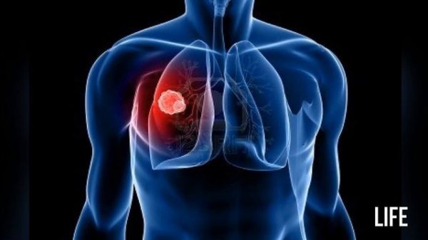 Первые признаки туберкулёза.