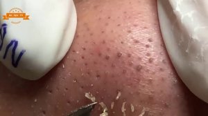 Удаление прыщей с носа и щек Spa  #077