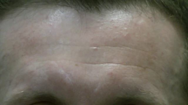 Убираем на лбу морщины