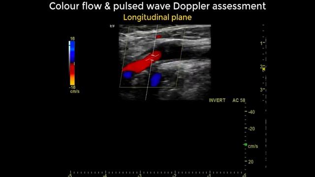 Intracranial occlusion of the internal carotid artery | Ultrasound смотреть онлайн