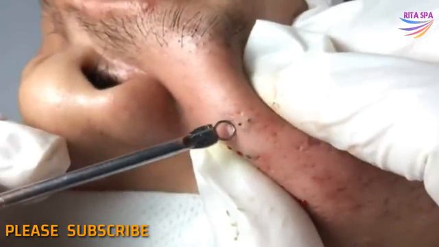 BLACKHEADS REMOVAL on face | how to get rid of blackheads & whiteheads series acne treatment #020 смотреть онлайн