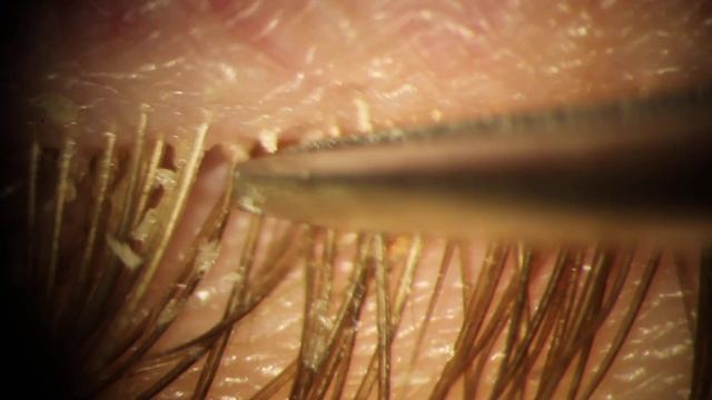 Demodex Mites Removed from Eyelid Eyelashes смотреть онлайн