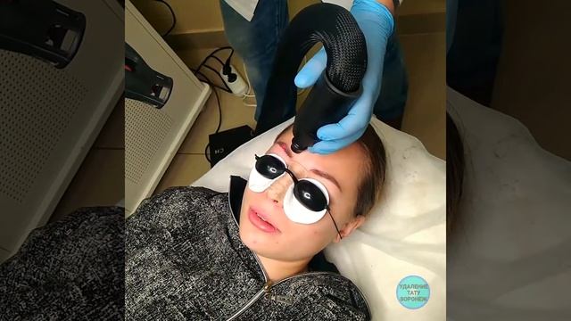 Лазерное удаление Татуажа Воронеж смотреть онлайн