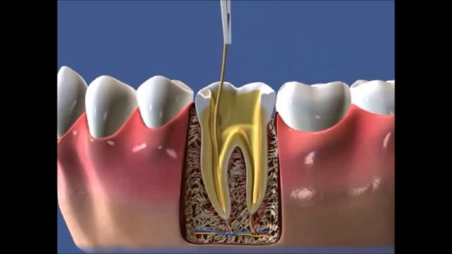 Пломбирование корневых каналов зуба смотреть онлайн