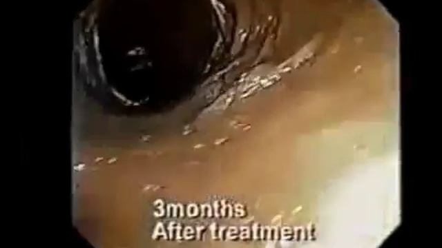 Очищение кишечника щелочной ионизированной водой. смотреть онлайн