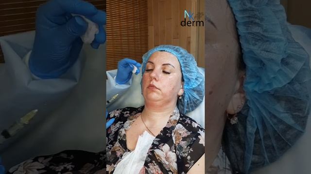 Липолитики в нижнюю треть лица: прямой + непрямой. смотреть онлайн