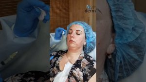 Липолитики в нижнюю треть лица: прямой + непрямой.