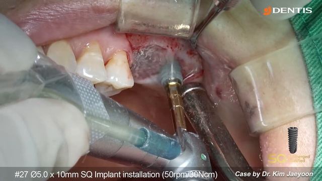 [DENTIS Implant] Crestal & lateral sinus lift with SAVE SINUS KIT and implant placement смотреть онлайн