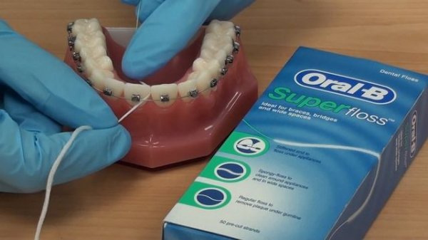 How to use Superfloss with fixed braces.
