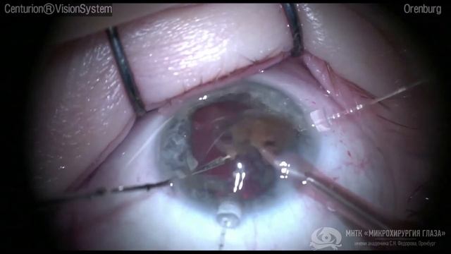 ФЭК при подвывихе хрусталика 2 степени с подшиванием ИОЛ к радужке