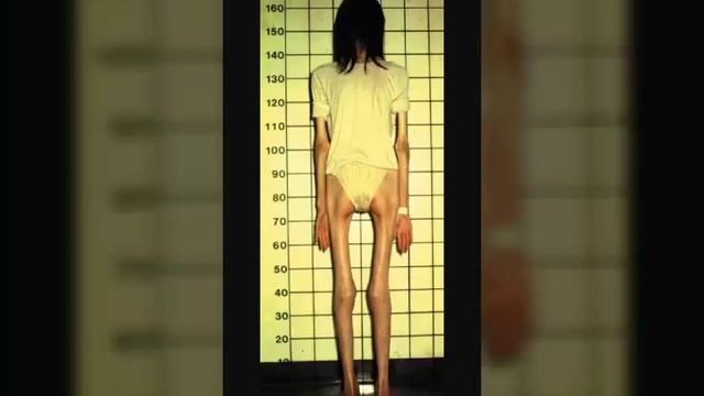 Анорексия подбор фото