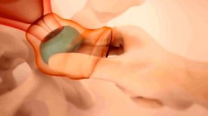 Установка акушерского пессария Арабин | Арабин.рф