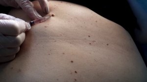 Удаление кератомы на коже тела электрокоакуляцией