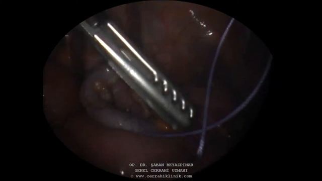 5 MM KAMERA İLE PEDİATRİK LAPAROSKOPİK APPENDEKTOMİ смотреть онлайн