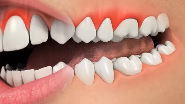 Удлинение коронки зуба с помощью лазера