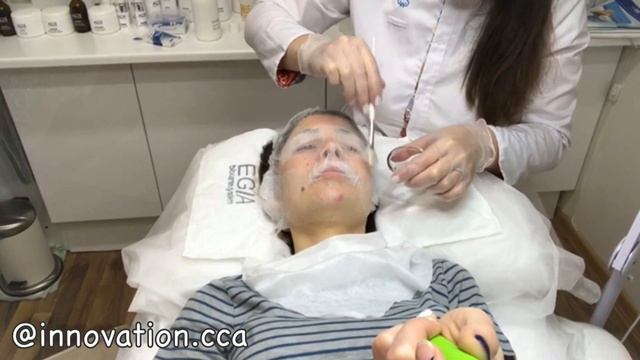 АЛМАЗНАЯ МИКРОДЕРМАБРАЗИЯ. КАРБОКСИТЕРАПИЯ / САМЫЙ КРУТОЙ КОСМЕТОЛОГ!!! смотреть онлайн