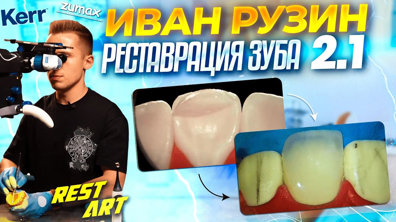 Реставрация зуба 2.1 - Иван Рузин | RestART смотреть онлайн